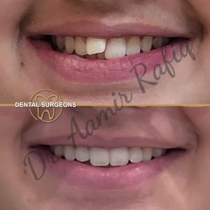 Discover the Best Dentist in Lahore: Dr. Aamir Rafiq at Dental Surgeons Clinic Before and after orthodontic treatment for teeth alignment