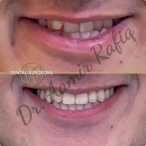 Discover the Best Dentist in Lahore: Dr. Aamir Rafiq at Dental Surgeons Clinic Before and after orthodontic treatment for teeth alignment