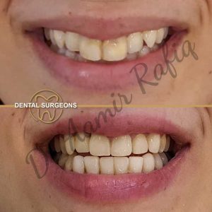 Discover the Best Dentist in Lahore: Dr. Aamir Rafiq at Dental Surgeons Clinic Smile transformation using veneers