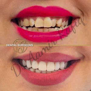 Discover the Best Dentist in Lahore: Dr. Aamir Rafiq at Dental Surgeons Clinic Dental veneers correcting discolored and misaligned teeth
