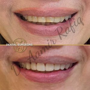 Discover the Best Dentist in Lahore: Dr. Aamir Rafiq at Dental Surgeons Clinic Smile transformation using veneers