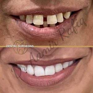 Discover the Best Dentist in Lahore: Dr. Aamir Rafiq at Dental Surgeons Clinic Full Mouth Rehabilitation - Hollywood Smile Makeover at Dental Surgeons Lahore