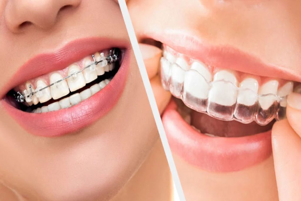 Braces vs Aligners: What’s Best for Your Smile? by Dr. Aamir Rafiq